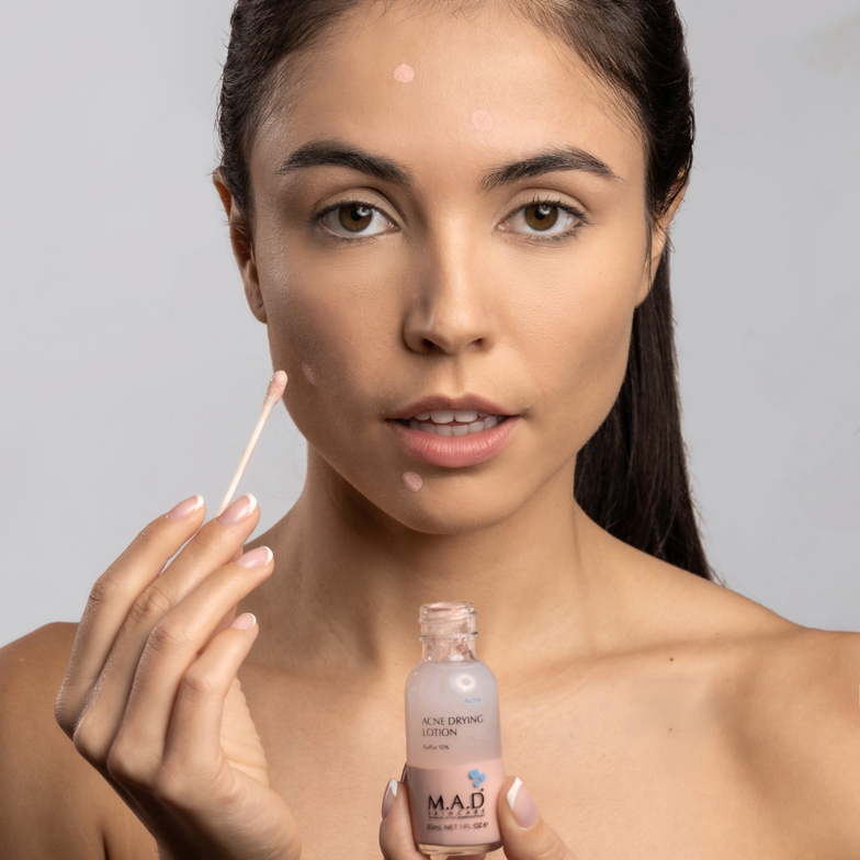 Acne Drying Lotion