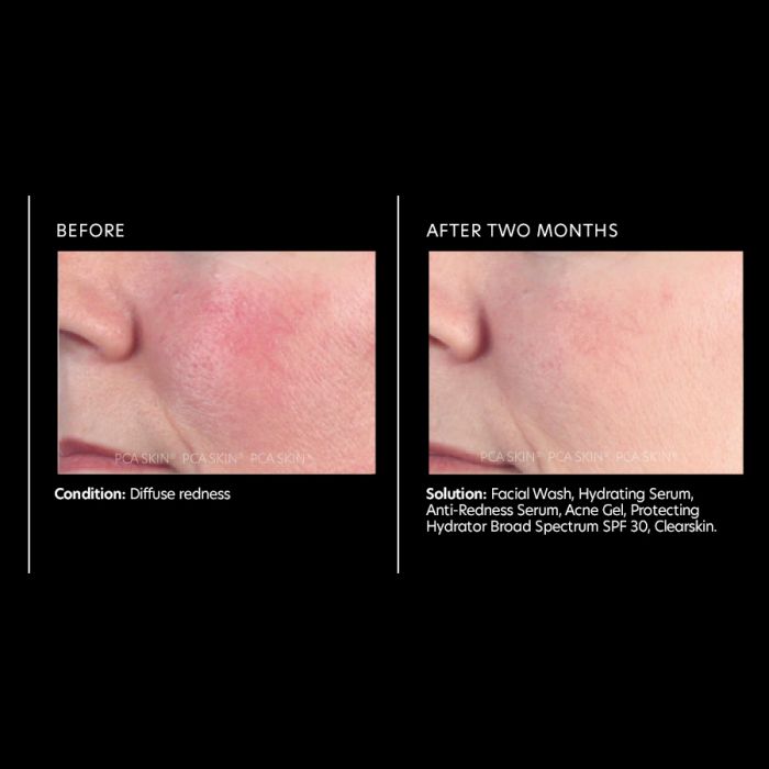 Anti-Redness Serum (1 fl. oz.)