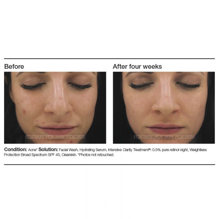 Intensive Clarity Treatment 0.5% Pure Retinol Night (1 oz.)